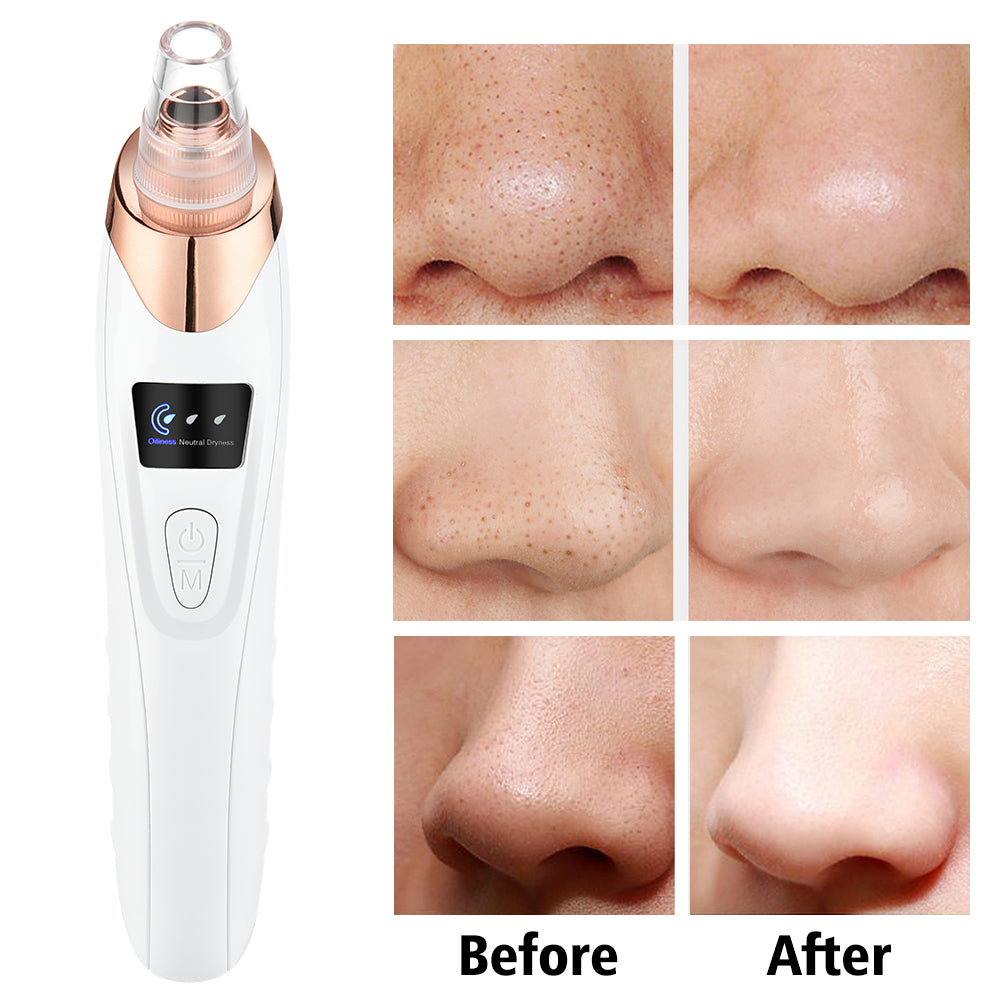 Advance 5-in-1 Pore Cleanser and Blackhead Removal Device Clear Your Skin with Every Use